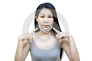 Young asian woman wearing medical face mask  her hand point at pimple on chin,Skin allergy,acne from wearing a mask