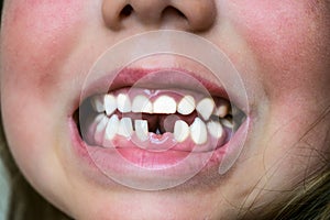 Young baby`s teeth are shown close-up. A child`s smile without one tooth
