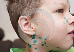 Boy with chicken pox photo
