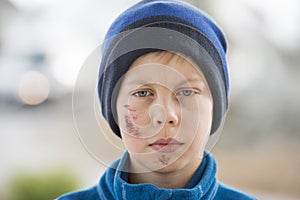Young boy with a face injury