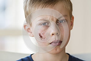 Young boy with face injury