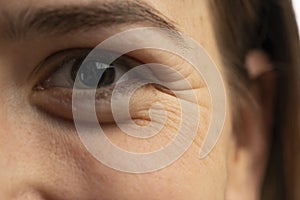 Young caucasian women eye wrinkles closeup