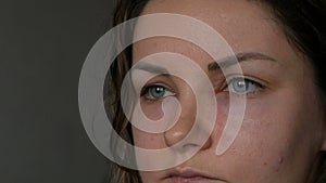 Young girl with an allergic reaction on the face and eyes, Quincke`s edema. Swelling of the face from nose to eyes in a