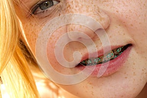 Young girl with freckles and braces