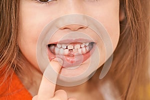 Young girl point on milk tooth. Baby losing teeth