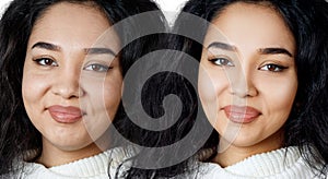 Young girl with problem skin before and after retouch.