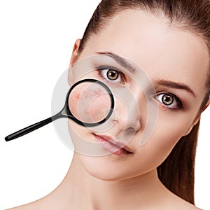 Young girl shows acne with magnifying glass.