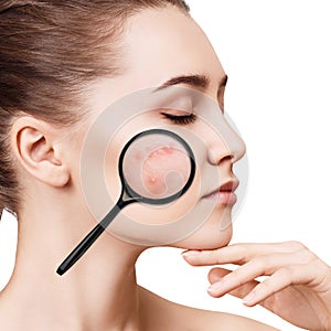 Young girl shows acne with magnifying glass.