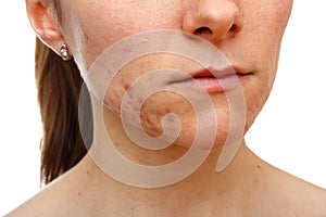 Young girl with skin problem