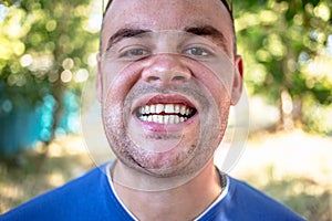 Young man with a chipped tooth