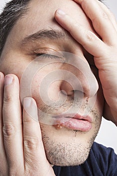 Young man with cold sore