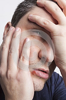 Young man with cold sore