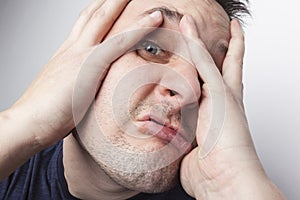 Young man with cold sore