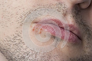 Young man with cold sore