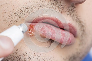 Young man with cold sore