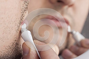 Young man with cold sore