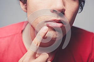 Young man with cold sore