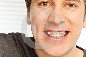 Young man with dental braces on his teeth photo