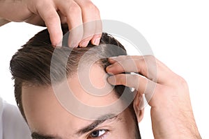 Young man with hair loss problem on white background