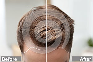 Young man before and after hair loss treatment against blurred background