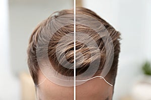 Young man before and after hair loss treatment against blurred background