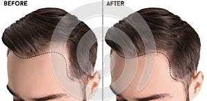 Giovane uomo Prima un dopo capelli perdita trattamento contro bianco 