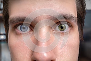 Young man with heterochromia - two different colored eyes. Contact lenses