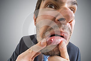 Young man is looking on ulcer or blister in his mouth in mirror photo