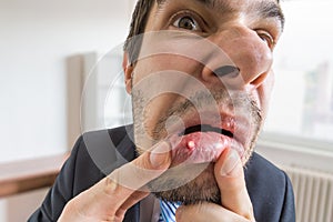 Young man is looking on ulcer or blister in his mouth in mirror