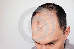 Young man losing hair on temples, close up