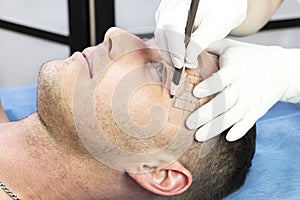 Young man microblading procedure to improve the condition of a mans eyebrows