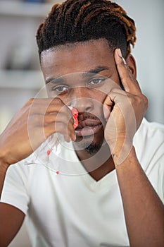 young man with nosebleed or epistaxis