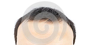 Young man serious hair loss problem for hair loss concept