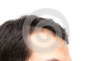 Young man serious hair loss problem for hair loss concept