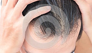 Young man serious hair loss problem for hair loss concept