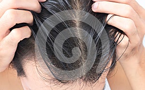 Young man serious hair loss problem for hair loss concept