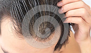 Young man serious hair loss problem for hair loss concept