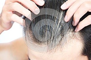 Young man serious hair loss problem for health care medical and