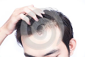 Young man serious hair loss problem for health care medical and