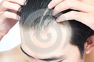 Young man serious hair loss problem for health care medical and