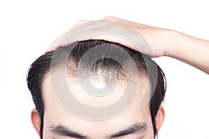 Young man serious hair loss problem for health care medical and