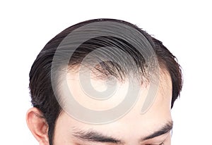 Young man serious hair loss problem for health care medical and