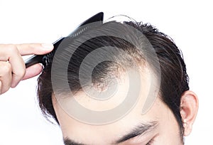 Young man serious hair loss problem for health care medical and