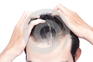 Young man serious hair loss problem for health care medical and