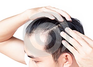 Young man serious hair loss problem for health care medical and shampoo product concept