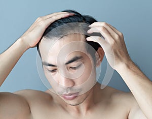 Young man serious hair loss problem for health care medical and shampoo product concept