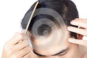 Young man serious hair loss problem for health care medical and shampoo product concept, selective focus