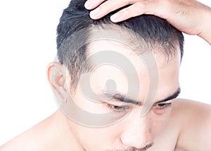 Young man serious hair loss problem for health care medical and shampoo product concept, selective focus