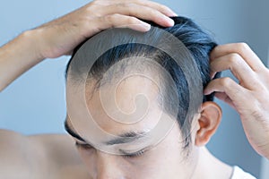 Young man serious hair loss problem for health care medical and shampoo product concept, selective focus