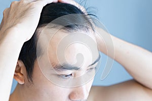 Young man serious hair loss problem for health care medical and shampoo product concept, selective focus